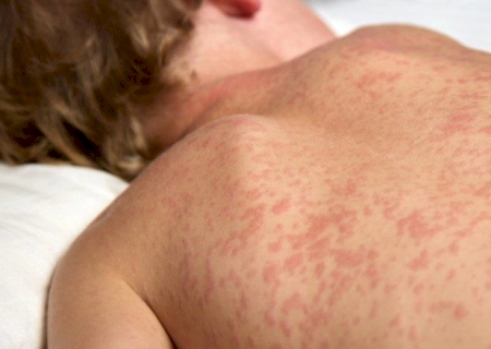 Governo intensifica vacinação para barrar avanço do sarampo em MS